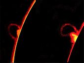 Deux photos successives d'un phénomène d'éruption solaire. Le disque solaire a été bloqué dans ces photos pour une meilleure visualisation de la proéminence de l'éruption.