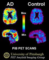 Denne PiB-PET-scanning viser en masse amyloid beta (Aβ) i hjernen hos en person med Alzheimers sygdom. Pib står for Pittsburgh-forbindelse B (PiB), som er en type farvestof, der sprøjtes ind i en person, før scanningen udføres. Amyloid beta absorberer PiB; når PET-scanningen udføres, fluorescerer (lyser) de områder, hvor der er Pib. PiB-PET-scanninger anvendes nu i forskningen til at påvise amyloid beta (Aβ) i den prækliniske fase (før der er symptomer).  