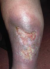 Untreated leg ulcer