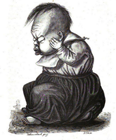 Child with the symptoms of hydrocephalus. Illustration by Michael Schmerbach in Rudolf Virchow, 1856.