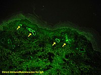 Mikrofotografie eines histologischen Schnitts der menschlichen Haut, der unter Verwendung eines Anti-IgA-Antikörpers für die direkte Immunfluoreszenz vorbereitet wurde. Die IgA-Ablagerungen befinden sich in den Wänden der kleinen oberflächlichen Kapillaren (gelbe Pfeile). Der blassgrüne wellige grüne Bereich oben ist die Epidermis, der untere faserige Bereich ist die Dermis.