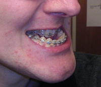 El prognatismo mandibular es cuando la mandíbula inferior sobresale.