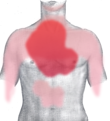 Il dolore che le persone sentono è nelle aree indicate in rosso: Molte persone indicano le aree in rosso scuro; quelle in rosso chiaro sono più raramente interessate. Questa immagine mostra il petto dal davanti.