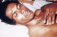 Une personne gravement déshydratée par le choléra. Il a les yeux enfoncés et la peau flasque à cause de la déshydratation.