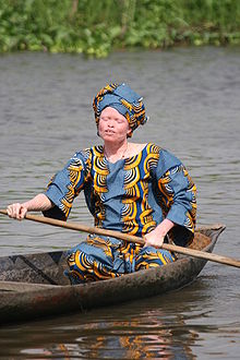 Some people with albinism are not completely white, but have dark moles. Photo from Benin