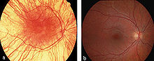 Fundus of a human with complete albinism (a) and a healthy eye (b)