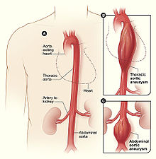 Obrázek A ukazuje normální aortu. Obrázky B a C ukazují aneuryzma v části aorty. Když aneuryzma praskne (jako prasklý balónek), může člověk během několika minut vykrvácet.