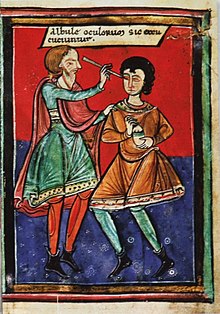 Eye surgery (cataract) in the Middle Ages; the text says: "The whitish opacities of the eyes are thus removed."