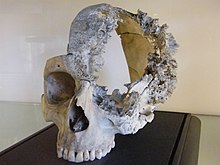 Human skull with extensive damage from a sarcoma (Hunterian Museum, Glasgow)