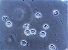 Veel bacillen (staafvormige bacteriën, hier weergegeven als zwart en boonvormig) zijn te zien tussen witte bloedlichaampjes, zoals te zien is door naar de urine te kijken via een microsoop. Deze veranderingen laten een urineweginfectie zien.