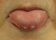 En person, der har bidt sig i tungespidsen under et anfald  