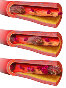 Illustratie van een bloedprop die door de bloedvaten reist tot hij vast komt te zitten. Een longembolie wordt vaak veroorzaakt door een bloedprop die zich ergens anders in het lichaam vormt, naar de longen reist en daar vast komt te zitten.  