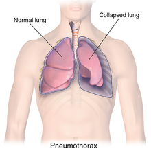 Pneimotoraksa ("sabrukušas plaušas") ilustrācija