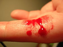 一个外部出血的例子：在身体外可以看到出血。