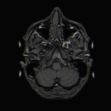 MRI slice images of a human brain (transverse plane), shown as a sequence from bottom to top.