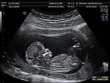 Sonographic image of a fetus at 12 weeks of gestation