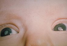 Deze baby is geboren met cataract (troebele witte lenzen in de ogen) veroorzaakt door rodehond.  