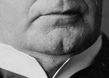 The chin of William McKinley with chin dimple