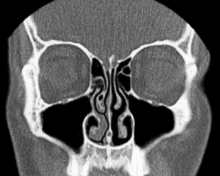 Nasal turbinates in CT (coronary stratification)