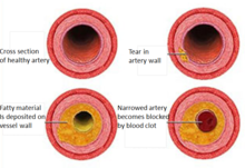 Coronaire hartziekte : Hartaanval: hierbij komt een bloedstolsel plotseling vast te zitten in een van de nauwe bloedvaten.  