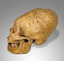 Um crânio humano que foi deformado. Este é um crânio Proto-Nazca do Peru.