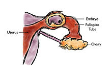 Un diagrama de un embarazo ectópico, con el feto atascado en la trompa de Falopio.