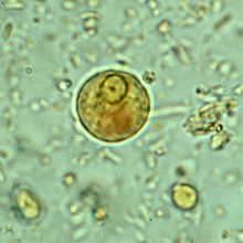 E. histolytica/E. dispar 囊肿在湿裱褙中用碘酒染色。这个早期的囊肿只有一个核，可以看到一个糖原块（棕色染色）。