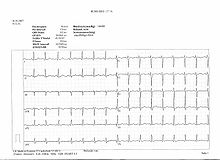 A normal 12-lead EKG...