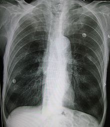 Rentgen klatki piersiowej osoby z rozedmą. Na strzałce w lewym płucu (po prawej stronie zdjęcia) widać słaby, pęcherzykowaty odcinek, który wygląda jak upiorna kiść winogron. To jest rozedma