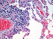 Mikroskopisk bild av ett histologiskt prov av mänsklig lungvävnad färgad med hematoxylin och eosin.  