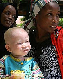 African mother with her child affected by albinism