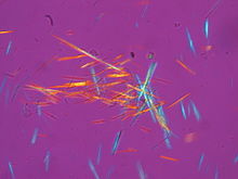 Barras de cristales de ácido úrico (MSU) de una muestra de líquido sinovial fotografiada al microscopio con luz polarizada.  
