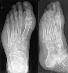 Goutte sur les radiographies d'un pied gauche. La goutte apparaît à l'endroit typique à la base de la plus grande articulation de l'orteil. Notez également le gonflement des tissus mous à la bordure latérale du pied.