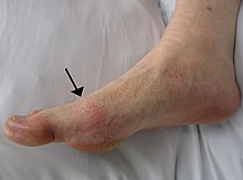 Gota que se presenta en la articulación de la base del dedo gordo del pie. Observe el ligero enrojecimiento de la piel sobre la articulación.  