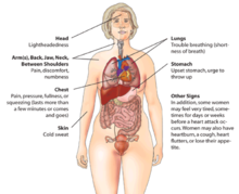 Hartaanval ( myocard infarct) Waarschuwingssymptomen bij vrouwen.