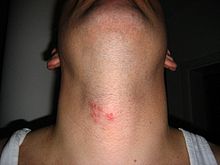 Shingles on the neck along the C3 with pain behind the right ear