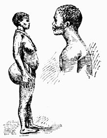 Khoikhoi mulher e homem (desenho de 1900). A mulher está exibindo esteatopenia.