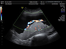 Ultrasound image of the placenta and umbilical cord with color Doppler imaging of the three umbilical vessels, at 20 weeks of gestation.