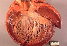 Dilated left ventricle cardiomyopathy. Opened heart
