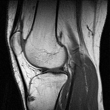 MRI image of a human knee joint, in sagittal slices