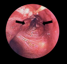 Vista de los crecimientos cancerosos en las vías respiratorias del pulmón izquierdo, vistos a través de un broncoscopio.  