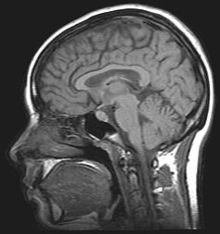 Een foto van een MRI-scan van het menselijk hoofd.