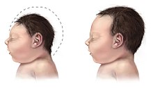 Ett barn med mikrocefali (till vänster) jämfört med ett barn med typisk huvudstorlek. Zikafeber verkar orsaka mikrocefali hos foster  