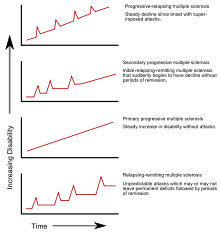 Vier grafieken die laten zien hoe de ernst van de MS-symptomen in de loop van de tijd op verschillende manieren kan toenemen en afnemen.