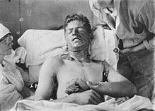 Oběť s popáleninami od yperitu v první světové válce