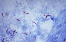 Mycobacterium tuberculosis in Ziehl-Neelsen stain (acid-fast rods)