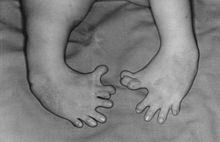 Barn som fötts av en mamma som tagit thalidomid under graviditeten  