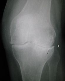 Röntgenfoto van knie met artrose.  