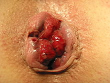 III degree hemorrhoidal disease, in which the anatomical location of the main hemorrhoidal nodes at 3, 7 and 11 o'clock can be clearly seen
