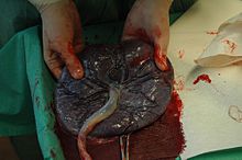 Una placenta con el cordón umbilical unido  